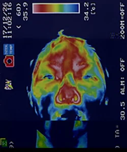 突発性難聴の原因｜ストレスで血流が低下した顔（治療前）