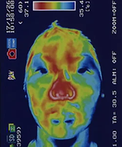 突発性難聴の原因|鍼治療で血流が改善した顔(治療後)