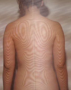 筋緊張が整って痙性斜頸が起こりにくい体質になった背骨のモアレトポグラフィー