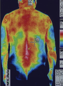 環椎・軸椎不安定症｜背中の温度分布（治療後）
