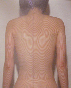 頚椎ヘルニア｜背骨の側弯（治療前）