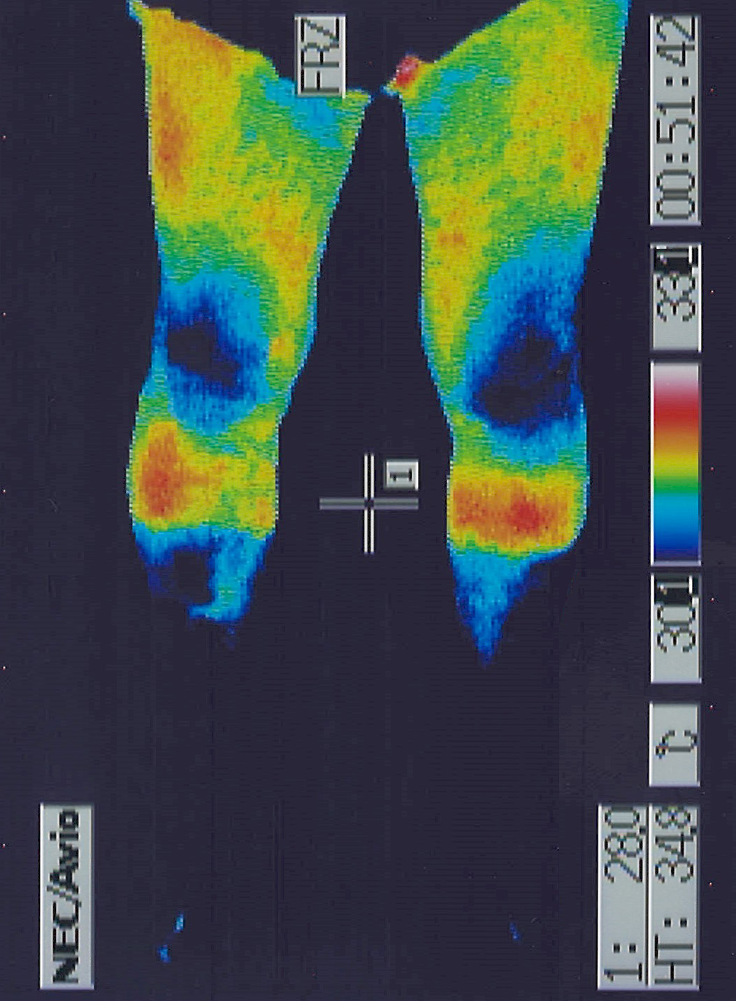 中心性脊髄損傷で代謝や体温が低下した足のサーモグラフィー