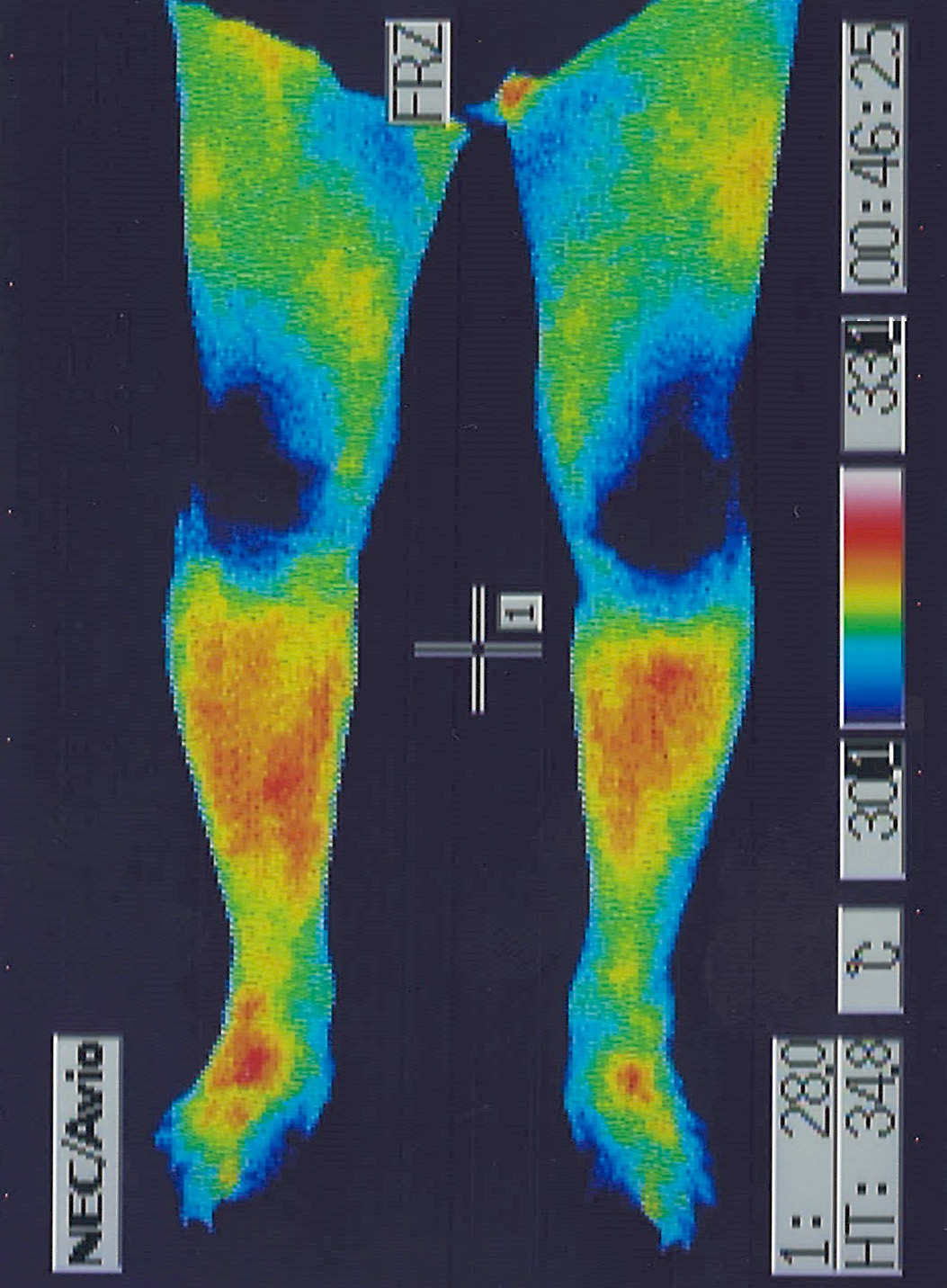 中心性脊髄損傷で代謝や体温が改善した足のサーモグラフィー