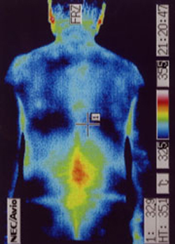 筋ジストロフィーの原因｜自律神経異常｜背部の温度分布（治療前）
