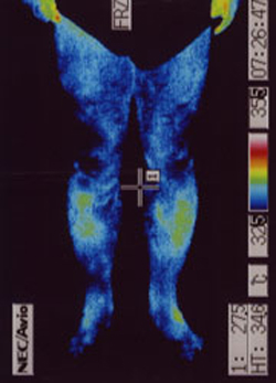 筋ジストロフィーの原因｜自律神経異常｜足前の温度分布（治療前）