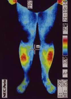 筋ジストロフィーの原因｜自律神経異常｜足前の温度分布（治療後）