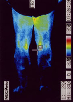 多系統萎縮症の原因｜自律神経異常｜足後の温度分布（治療前）