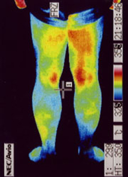 筋ジストロフィーの原因｜自律神経異常｜足後の温度分布（治療後）