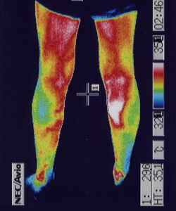 鍼治療で足の温度と血流良くなりパニック発作が起こりにくくなった足のサーモグラフィー