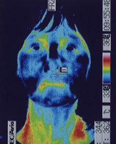パニック発作の原因となる顔の温度変化を調べるサーモグラフィー画像