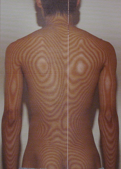 ぎっくり腰の検査・初診時のモアレ画像