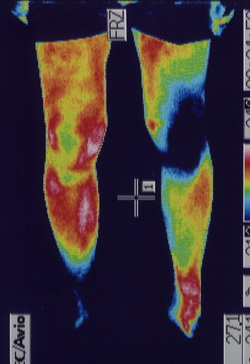 特発性側湾症の原因｜筋力低下や背中の温度分布（治療前）