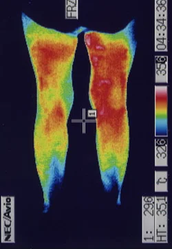 痙性斜頸の原因|筋力低下や腕から手にかけての温度分布(治療後)