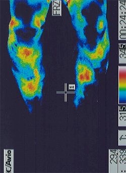 筋萎縮側索硬化症｜足の温度分布（治療前）