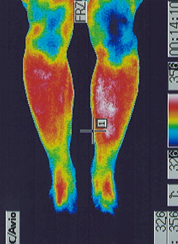 筋萎縮側索硬化症｜足の温度分布（治療後）