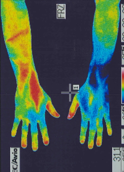 手鍼治療前の手の温度