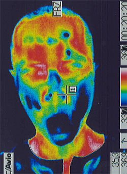 脊髄小脳変性症の鍼灸治療｜口周りの温度分布（治療前）