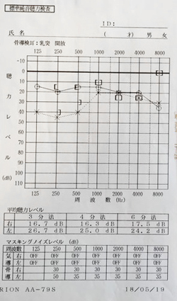 突発性難聴で埼玉県から通院されたＪ.Ｓ.様の治療前のオージオグラム
