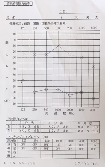 突発性難聴の原因|ストレスで血流が低下した顔(治療前)