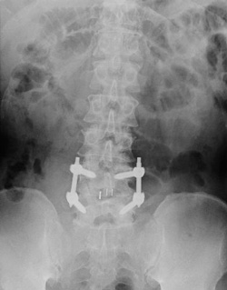 腰椎分離すべり症の手術後に悪化した腰痛のレントゲン（背面）