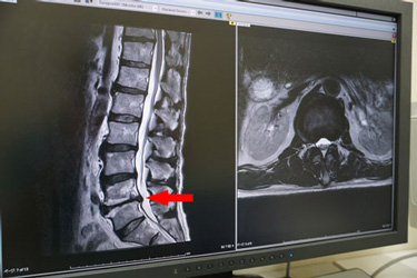 椎間板がつぶれたMRIの画像